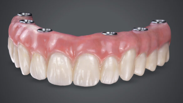 Full Mouth Dental Implants in Gandhinagar: Cost, Single Tooth Implant Prices, Procedure & Complete Guide (2026) – Nova Dental Hospital-The best dental implant specialist in Gagndhinagar