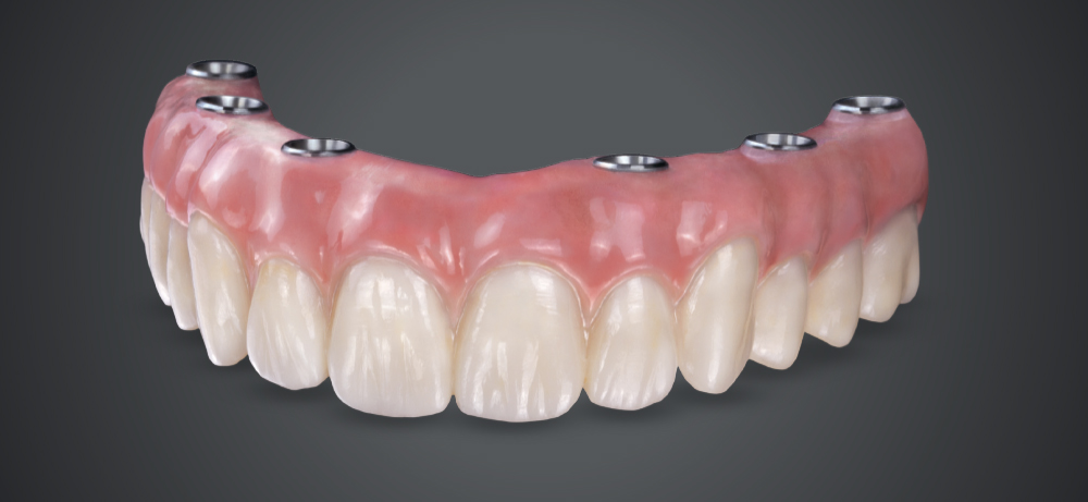 Full Mouth Dental Implants in Gandhinagar: Cost, Single Tooth Implant Prices, Procedure & Complete Guide (2026) – Nova Dental Hospital-The best dental implant specialist in Gagndhinagar