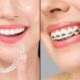 Invisalign vs Braces: Which Is Better for You in 2026? — Expert Guide by Nova Dental Hospital – The Best Dental clinic in Gandhinagar