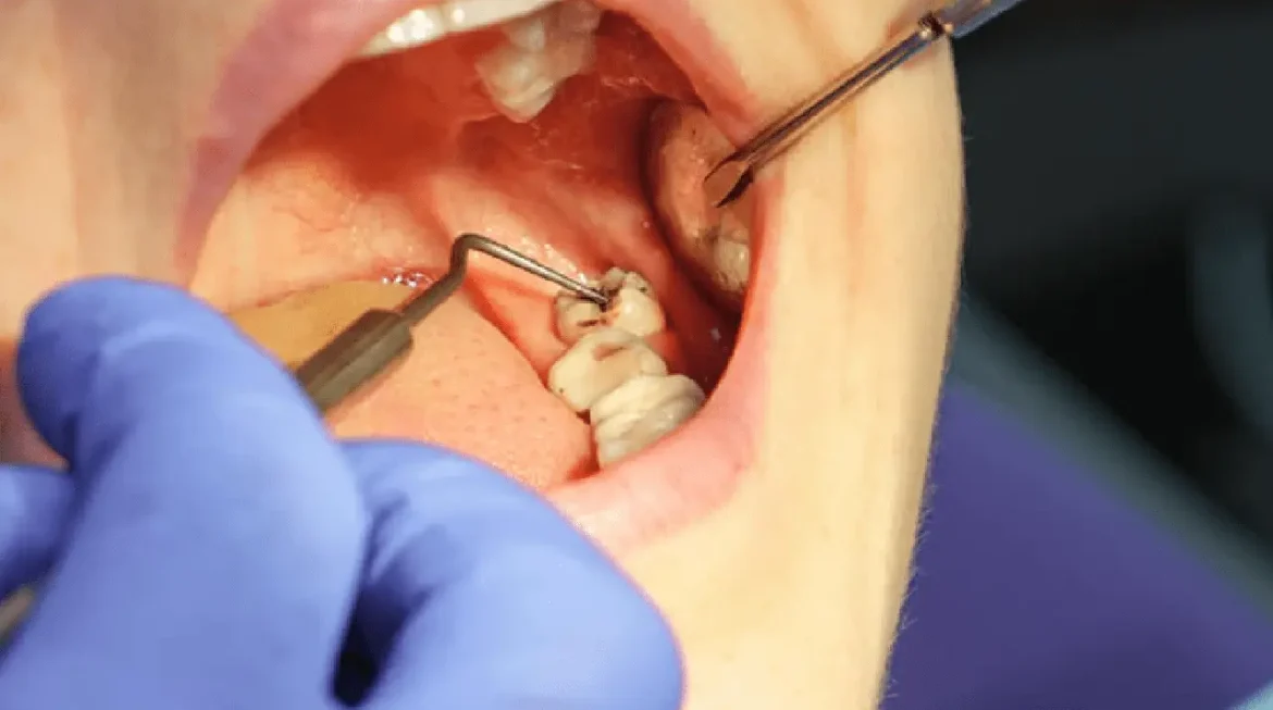 Wisdom Tooth Surgery in Gandhinagar: Complete Guide 2026 – Nova Dental Hospital – Best Dental Surgeon in Gandhinagar