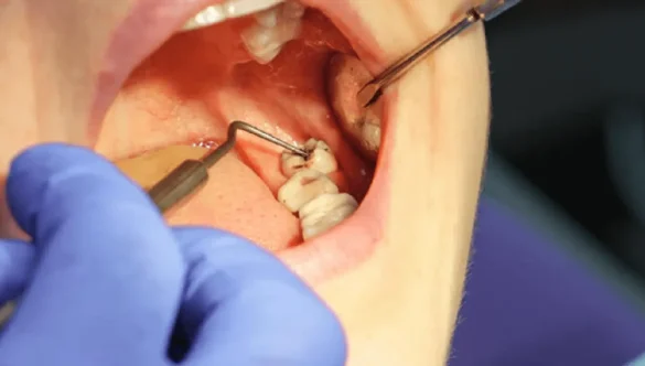 Wisdom Tooth Surgery in Gandhinagar: Complete Guide 2026 – Nova Dental Hospital – Best Dental Surgeon in Gandhinagar