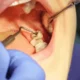 Wisdom Tooth Surgery in Gandhinagar: Complete Guide 2026 – Nova Dental Hospital – Best Dental Surgeon in Gandhinagar