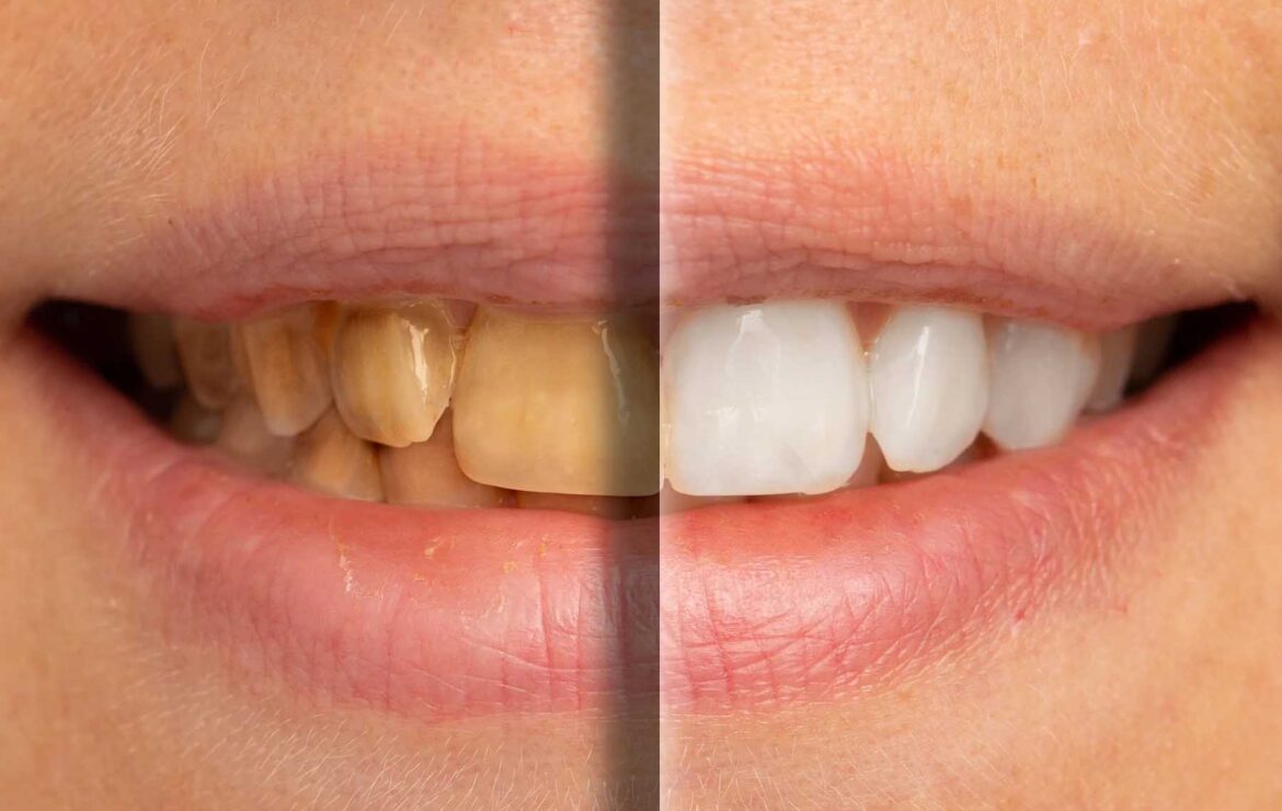 Can Yellow Teeth Become White Again? Your Complete Guide