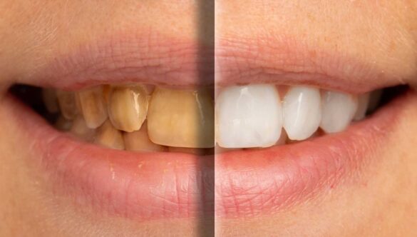 Can Yellow Teeth Become White Again? Your Complete Guide