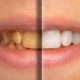 Can Yellow Teeth Become White Again? Your Complete Guide