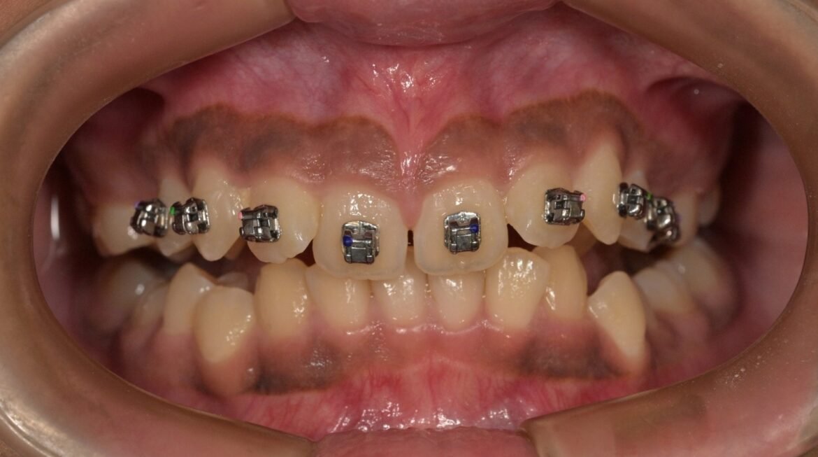 Can Crooked Teeth Be Fixed Without Braces? Alternative Options Explained