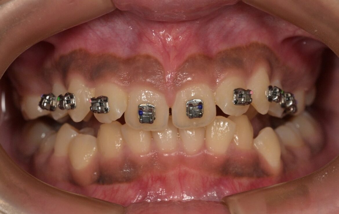 Can Crooked Teeth Be Fixed Without Braces? Alternative Options Explained