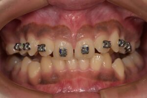 Can Crooked Teeth Be Fixed Without Braces? Alternative Options Explained