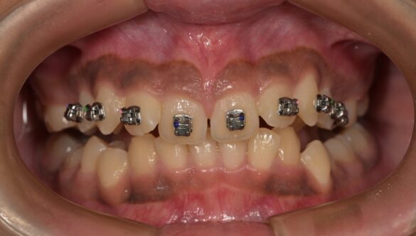 Can Crooked Teeth Be Fixed Without Braces? Alternative Options Explained