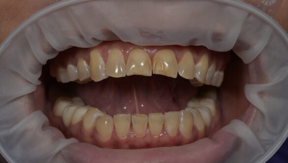 Can Crooked Teeth Be Fixed Without Braces? Alternative Options Explained