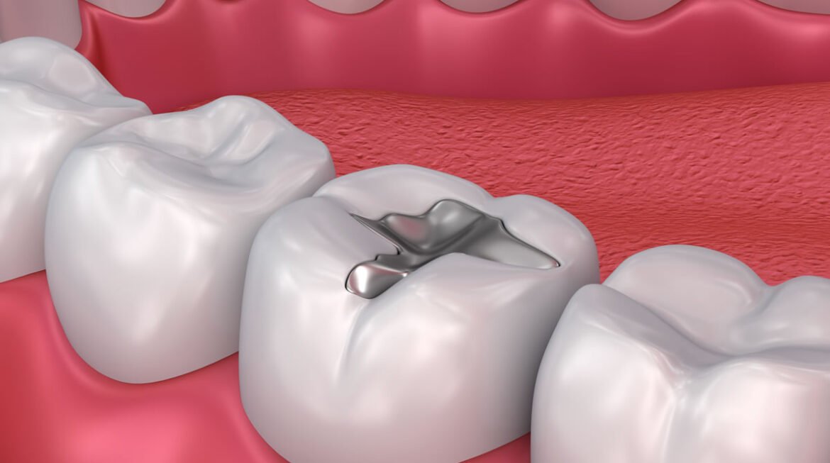 Can I Eat Normally After Getting a Dental Filling? Foods to Avoid & Recovery Tips
