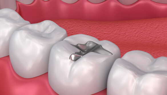 Can I Eat Normally After Getting a Dental Filling? Foods to Avoid & Recovery Tips