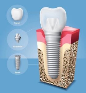 Dental implant components diagram showing fixture, abutment and crown at Nova Dental Hospital Gandhinagar