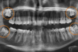 Making Wisdom Tooth Removal Safer with CBCT Scans