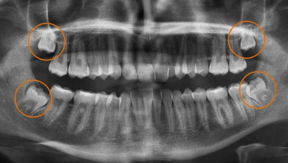 Making Wisdom Tooth Removal Safer with CBCT Scans