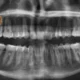 Making Wisdom Tooth Removal Safer with CBCT Scans