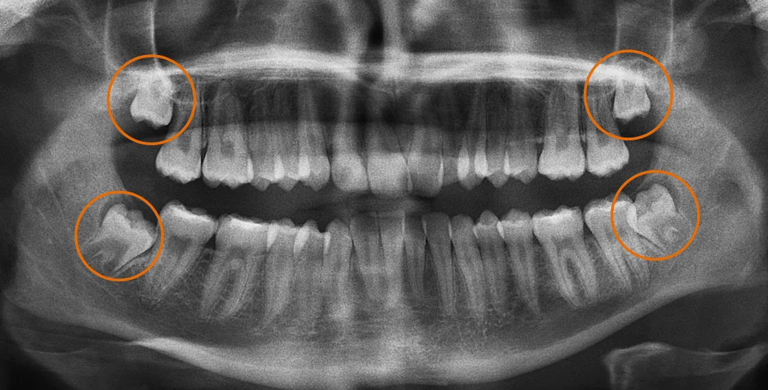 Making Wisdom Tooth Removal Safer with CBCT Scans