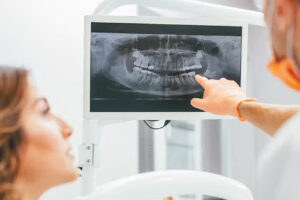 X-rays Before Dental Implants: Using 3D Tech for Success