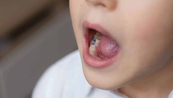 How Do I Know If My Child’s Baby Tooth Needs a Filling or Will It Just Fall Out?