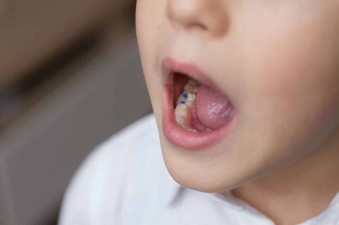 How Do I Know If My Child’s Baby Tooth Needs a Filling or Will It Just Fall Out?