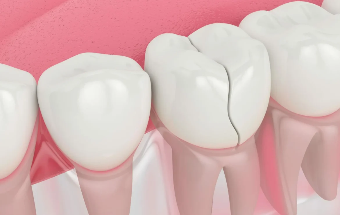 Can a Cracked Tooth Be Saved or Does It Need to Be Extracted?