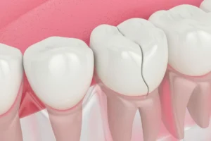 Can a Cracked Tooth Be Saved or Does It Need to Be Extracted?