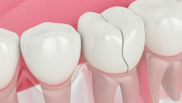 Can a Cracked Tooth Be Saved or Does It Need to Be Extracted?