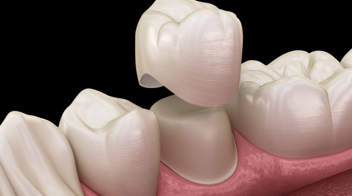 Will My Dental Crown Look Natural or Will People Notice It?