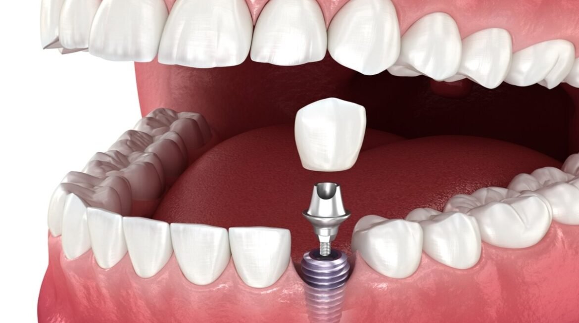 How Long Does It Take for a Dental Implant to Heal Completely?
