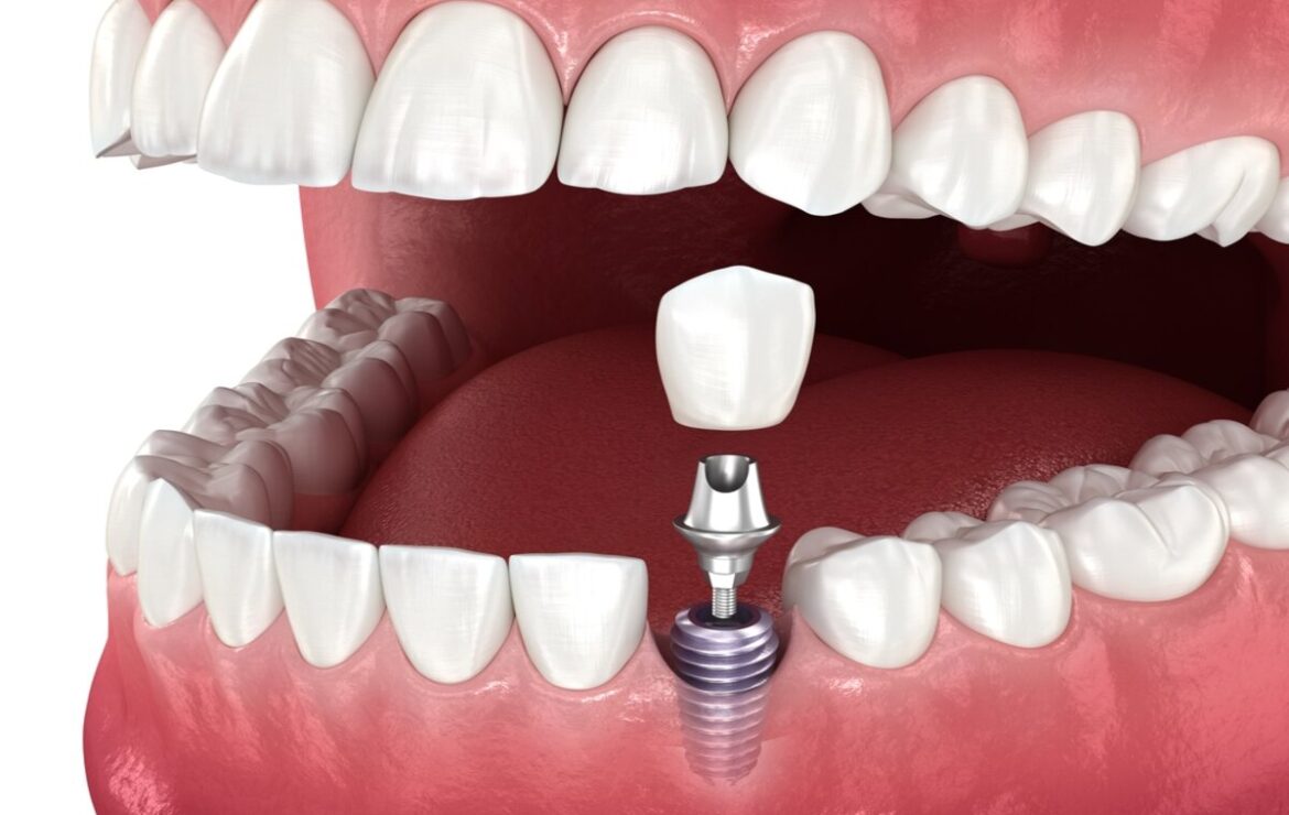 How Long Does It Take for a Dental Implant to Heal Completely?