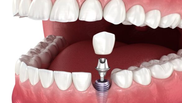 How Long Does It Take for a Dental Implant to Heal Completely?