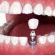 How Long Does It Take for a Dental Implant to Heal Completely?