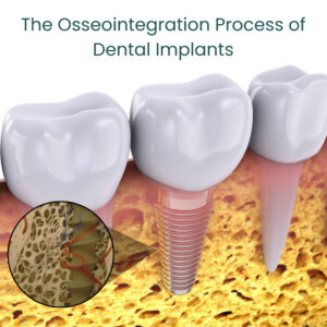 Osseointegration process showing bone fusion with dental implant in Gandhinagar