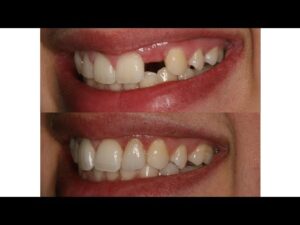 Before and after dental implant restoration showing natural-looking results at Nova Dental Gandhinagar