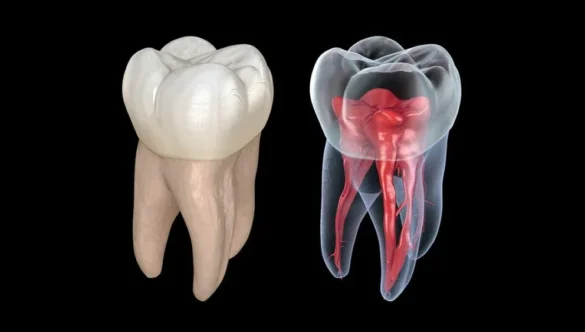 3D Scan for Root Canal: Finding Hidden Canals