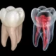 3D Scan for Root Canal: Finding Hidden Canals