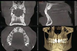 CBCT vs. OPG: Understanding Full Jaw 3D Imaging