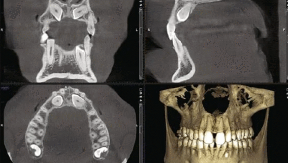 CBCT vs. OPG: Understanding Full Jaw 3D Imaging