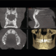 CBCT vs. OPG: Understanding Full Jaw 3D Imaging