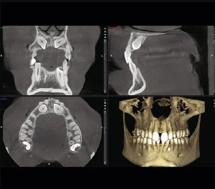 CBCT vs. OPG: Understanding Full Jaw 3D Imaging