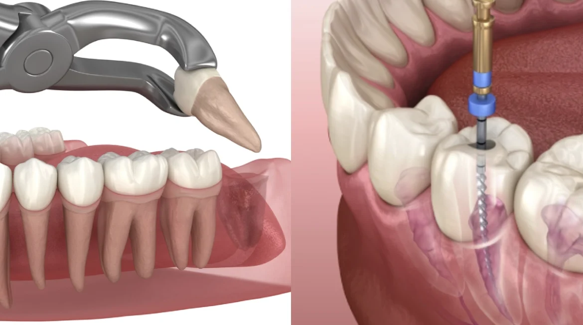 Root Canal vs Tooth Extraction: Which Is Actually the Better Choice?
