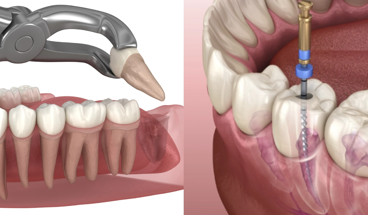 Root Canal vs Tooth Extraction: Which Is Actually the Better Choice?