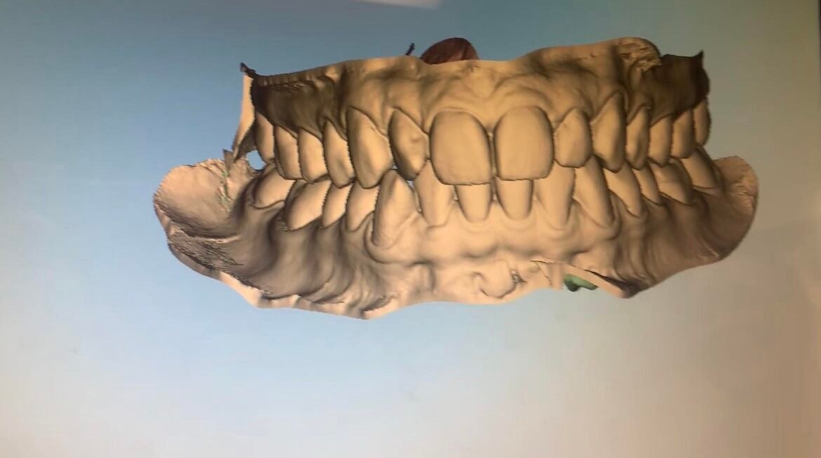 Digital 3D Scan for Braces and Smile Design