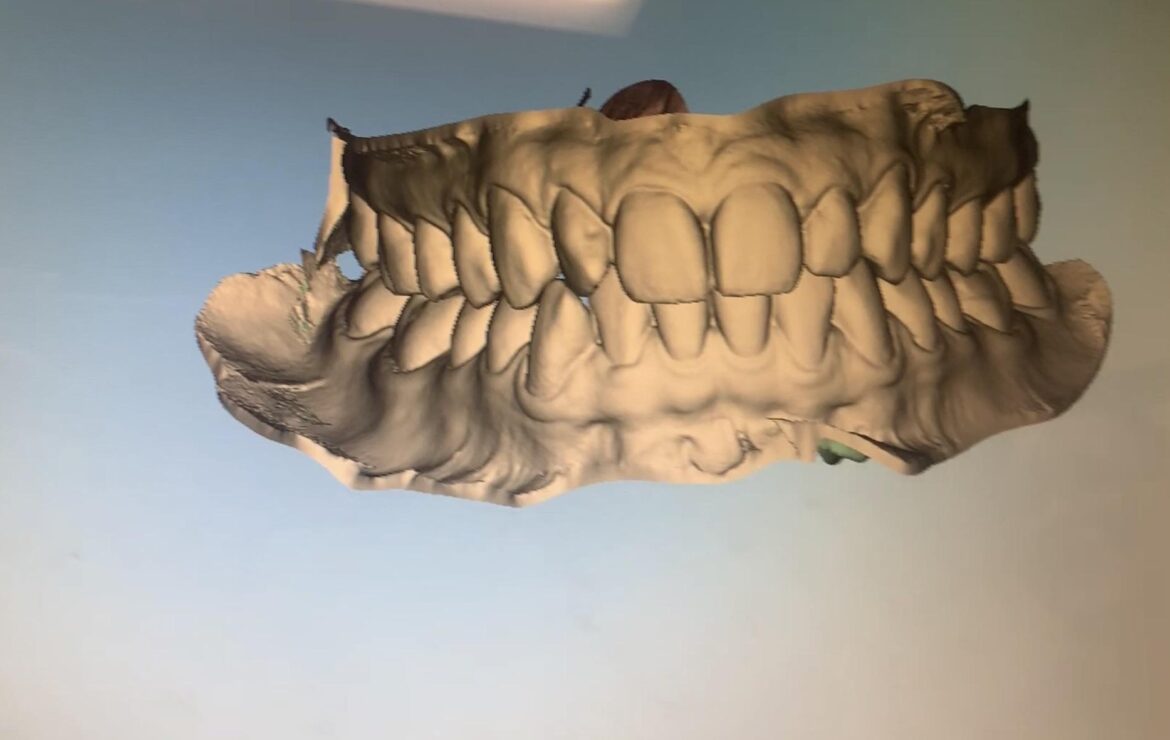 Digital 3D Scan for Braces and Smile Design
