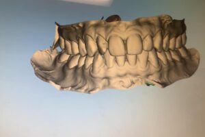 Digital 3D Scan for Braces and Smile Design