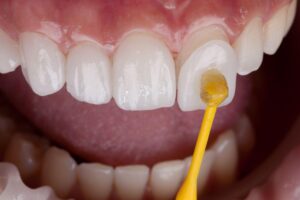 Dental Veneers: Are They Permanent, and What Happens to Your Natural Teeth?