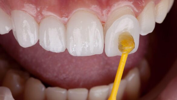 Dental Veneers: Are They Permanent, and What Happens to Your Natural Teeth?