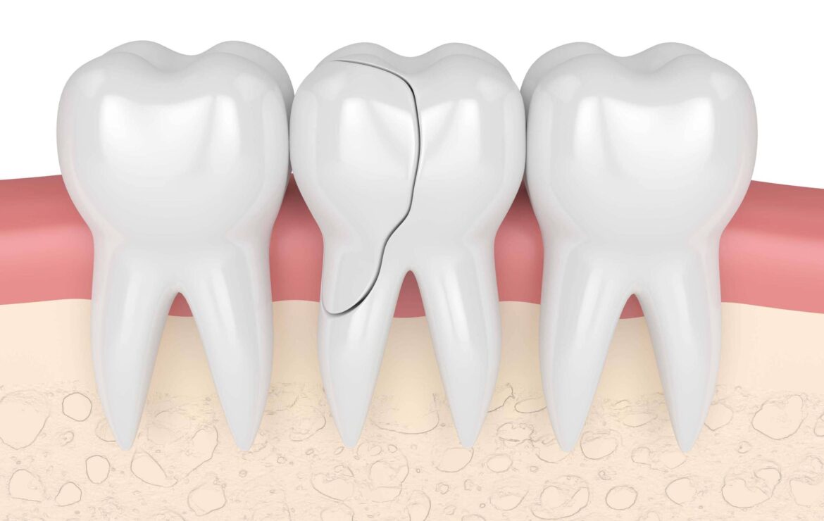 Can a Cracked Tooth Be Saved, or Does It Have to Come Out?