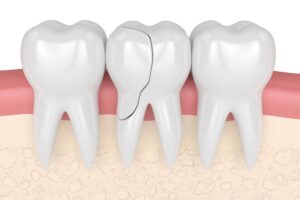 Can a Cracked Tooth Be Saved, or Does It Have to Come Out?