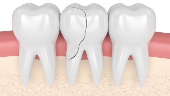 Can a Cracked Tooth Be Saved, or Does It Have to Come Out?
